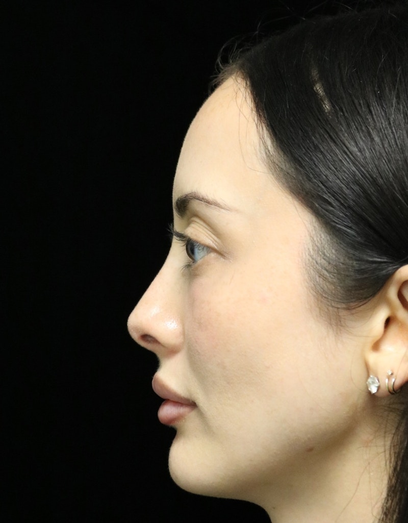 Beverly Hills Rhinoplasty Before & After Gallery - Patient 122052 - Image 6 Dr. Deepak Raj Dugar