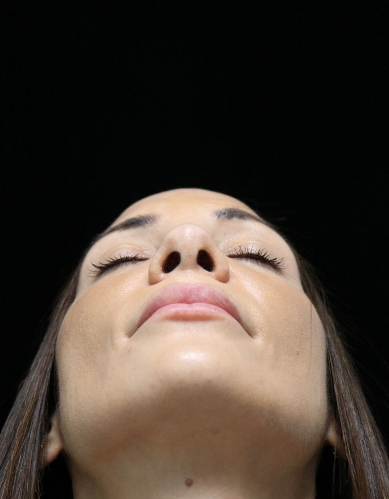 Beverly Hills Rhinoplasty Before & After Gallery - Patient 344565 - Image 14 Dr. Deepak Raj Dugar