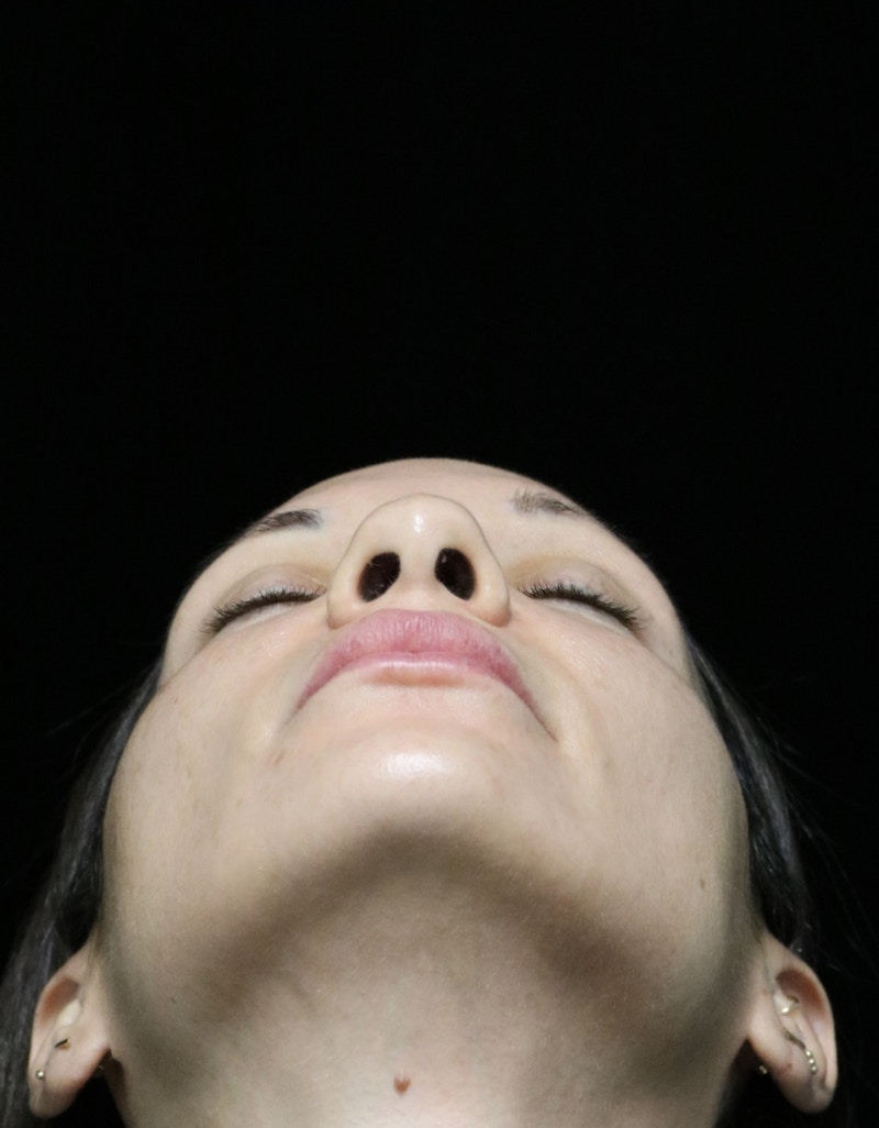 Beverly Hills Rhinoplasty Before & After Gallery - Patient 344565 - Image 13 Dr. Deepak Raj Dugar