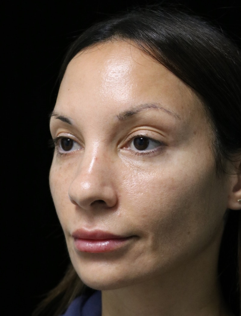 Beverly Hills Rhinoplasty Before & After Gallery - Patient 344565 - Image 7 Dr. Deepak Raj Dugar