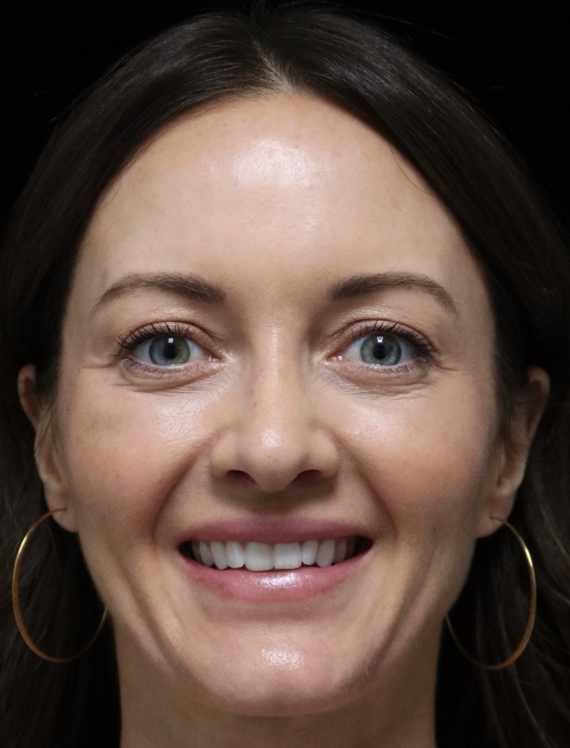 Beverly Hills Rhinoplasty Before & After Gallery - Patient 419015 - Image 12 Dr. Deepak Raj Dugar