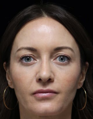 Beverly Hills Rhinoplasty Before & After Gallery - Patient 419015 - Image 10 Dr. Deepak Raj Dugar