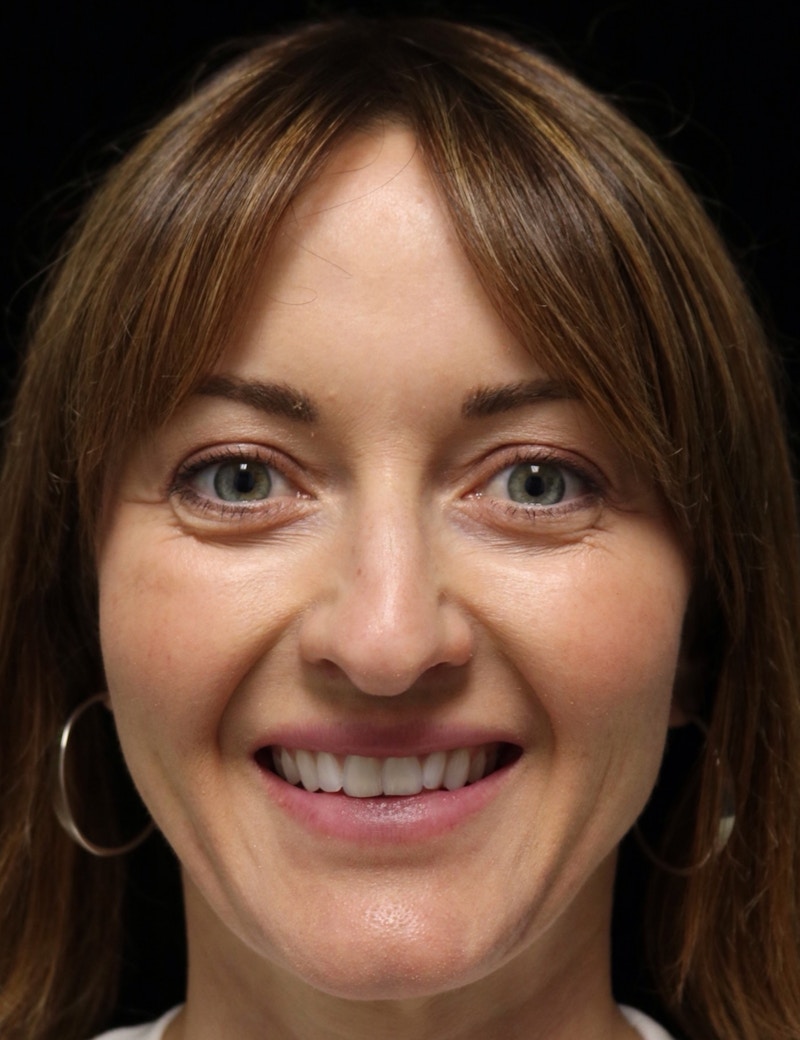 Beverly Hills Rhinoplasty Before & After Gallery - Patient 419015 - Image 11 Dr. Deepak Raj Dugar