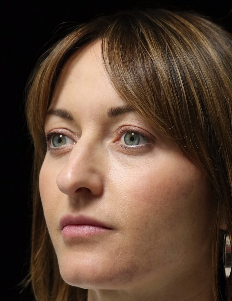 Beverly Hills Rhinoplasty Before & After Gallery - Patient 419015 - Image 7 Dr. Deepak Raj Dugar