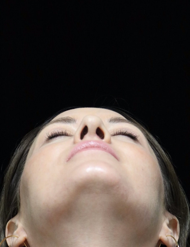 Beverly Hills Rhinoplasty Before & After Gallery - Patient 419015 - Image 14 Dr. Deepak Raj Dugar