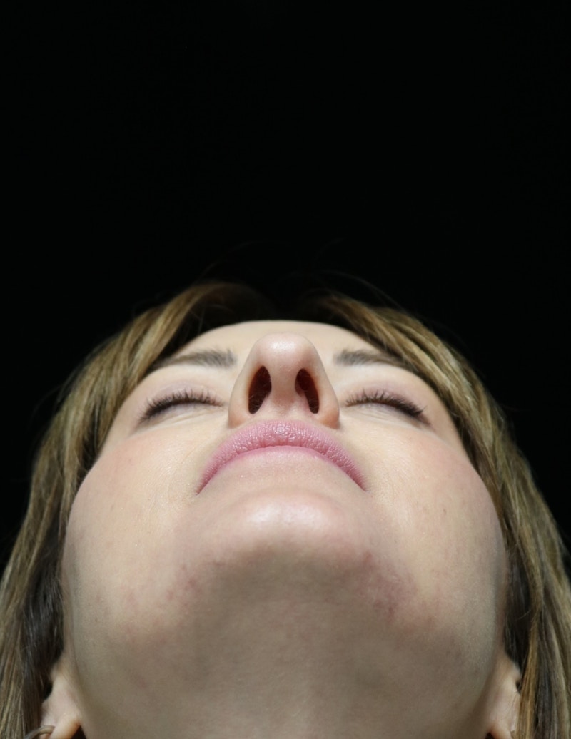 Beverly Hills Rhinoplasty Before & After Gallery - Patient 419015 - Image 13 Dr. Deepak Raj Dugar