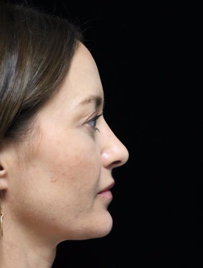 Beverly Hills Rhinoplasty Before & After Gallery - Patient 419015 - Image 2 Dr. Deepak Raj Dugar