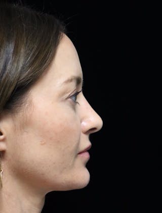 Beverly Hills Rhinoplasty Before & After Gallery - Patient 419015 - Image 2 Dr. Deepak Raj Dugar