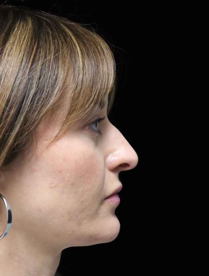 Beverly Hills Rhinoplasty Before & After Gallery - Patient 419015 - Image 1 Dr. Deepak Raj Dugar