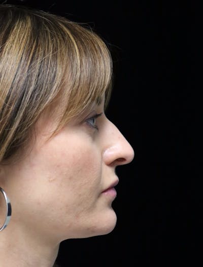 Rhinoplasty Before & After Gallery - Patient 419015 - Image 1