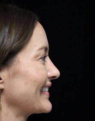 Beverly Hills Rhinoplasty Before & After Gallery - Patient 419015 - Image 4 Dr. Deepak Raj Dugar