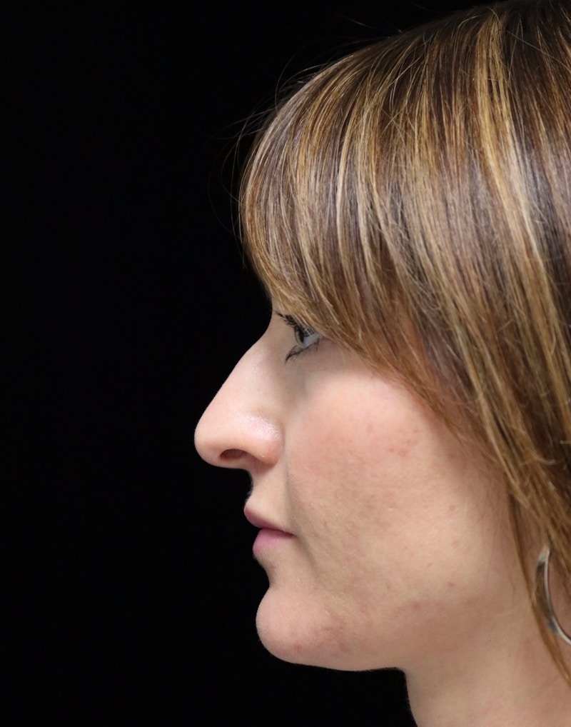 Beverly Hills Rhinoplasty Before & After Gallery - Patient 419015 - Image 5 Dr. Deepak Raj Dugar