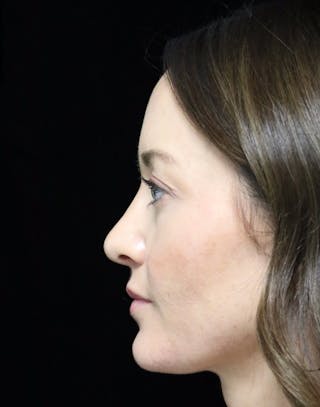 Beverly Hills Rhinoplasty Before & After Gallery - Patient 419015 - Image 6 Dr. Deepak Raj Dugar