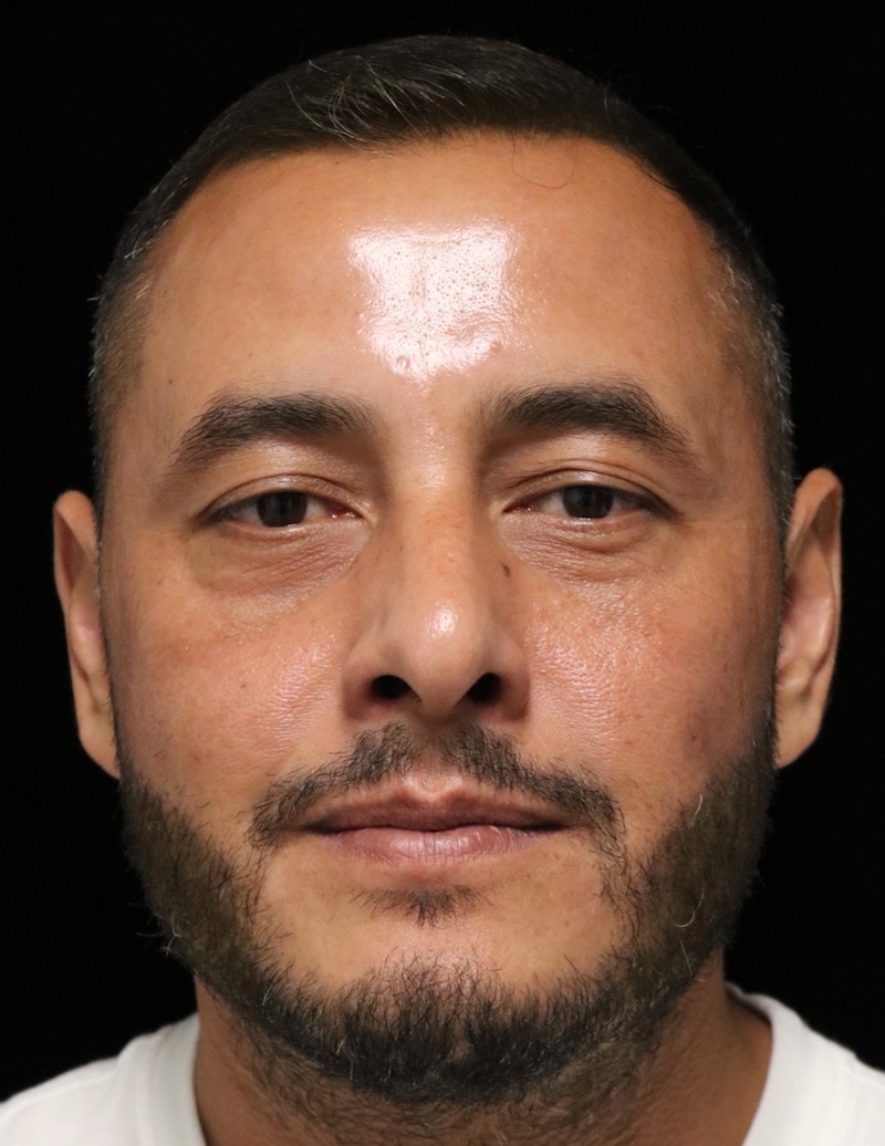 Beverly Hills Rhinoplasty Before & After Gallery - Patient 319616 - Image 10 Dr. Deepak Raj Dugar