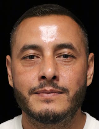 Beverly Hills Rhinoplasty Before & After Gallery - Patient 319616 - Image 10 Dr. Deepak Raj Dugar