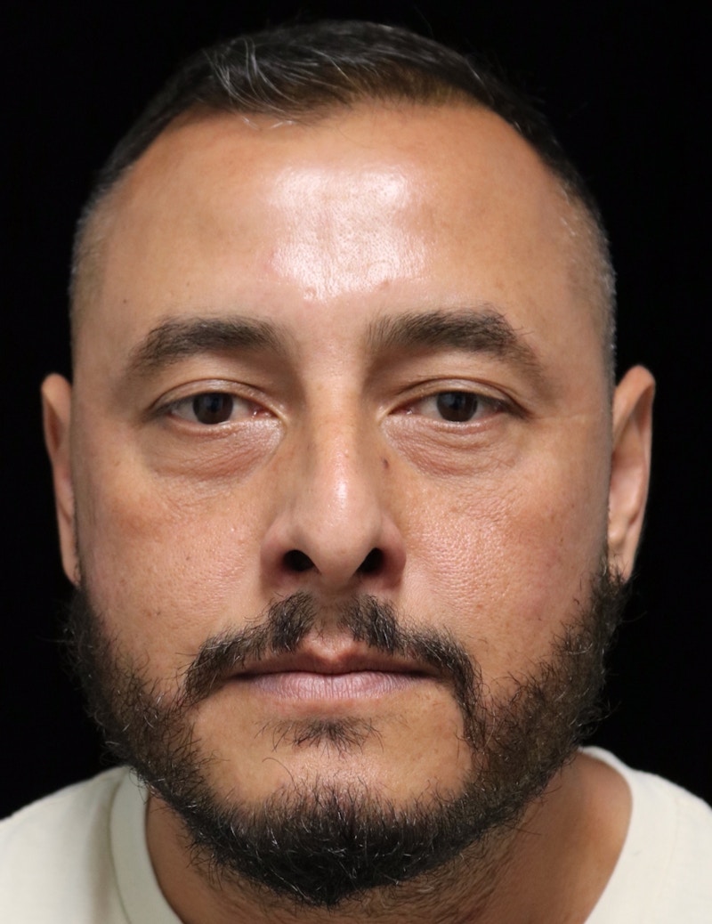 Beverly Hills Rhinoplasty Before & After Gallery - Patient 319616 - Image 9 Dr. Deepak Raj Dugar