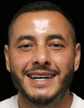 Beverly Hills Rhinoplasty Before & After Gallery - Patient 319616 - Image 12 Dr. Deepak Raj Dugar