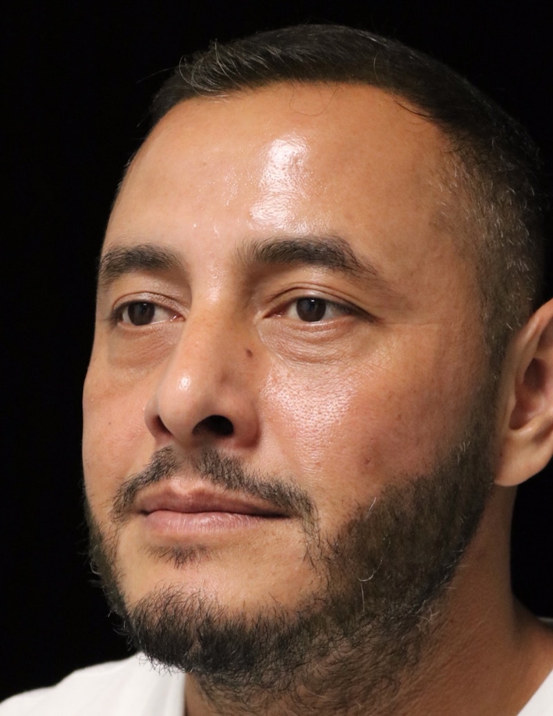 Beverly Hills Rhinoplasty Before & After Gallery - Patient 319616 - Image 8 Dr. Deepak Raj Dugar