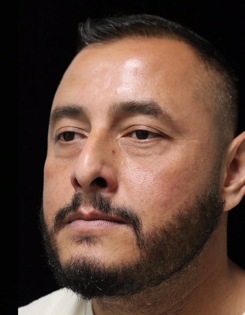 Beverly Hills Rhinoplasty Before & After Gallery - Patient 319616 - Image 7 Dr. Deepak Raj Dugar