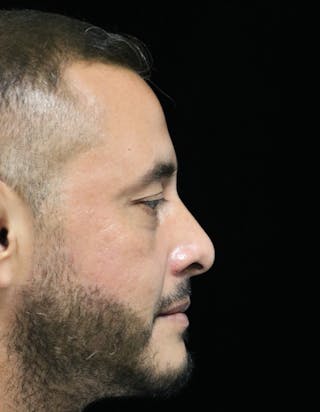 Beverly Hills Rhinoplasty Before & After Gallery - Patient 319616 - Image 2 Dr. Deepak Raj Dugar