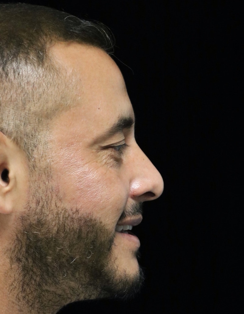 Beverly Hills Rhinoplasty Before & After Gallery - Patient 319616 - Image 4 Dr. Deepak Raj Dugar