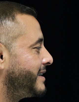 Beverly Hills Rhinoplasty Before & After Gallery - Patient 319616 - Image 4 Dr. Deepak Raj Dugar