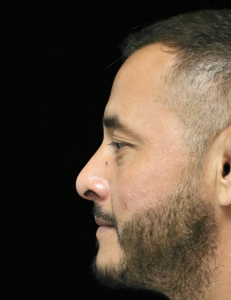 Beverly Hills Rhinoplasty Before & After Gallery - Patient 319616 - Image 6 Dr. Deepak Raj Dugar