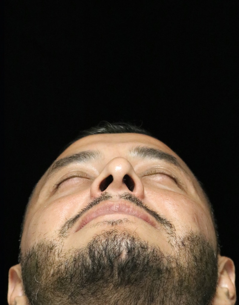 Beverly Hills Rhinoplasty Before & After Gallery - Patient 319616 - Image 14 Dr. Deepak Raj Dugar