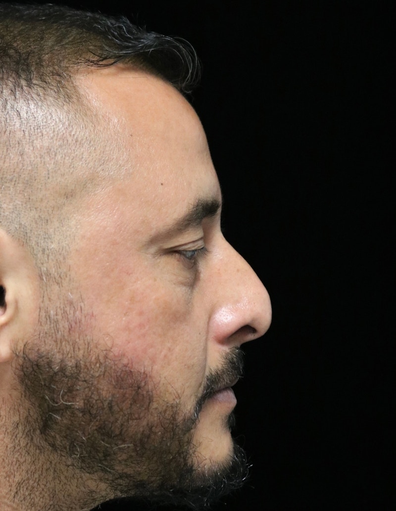 Beverly Hills Rhinoplasty Before & After Gallery - Patient 319616 - Image 1 Dr. Deepak Raj Dugar