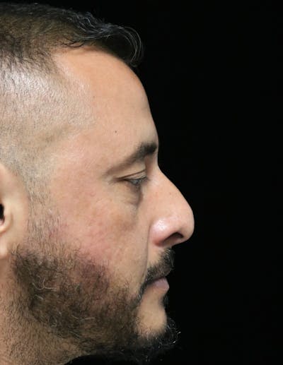 Rhinoplasty Before & After Gallery - Patient 319616 - Image 1