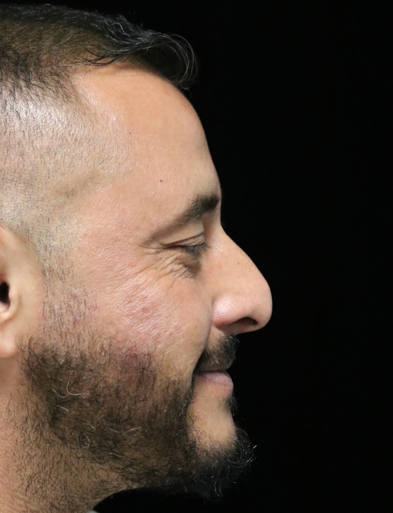 Beverly Hills Rhinoplasty Before & After Gallery - Patient 319616 - Image 3 Dr. Deepak Raj Dugar