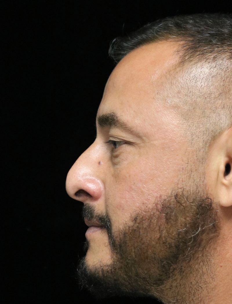 Beverly Hills Rhinoplasty Before & After Gallery - Patient 319616 - Image 5 Dr. Deepak Raj Dugar