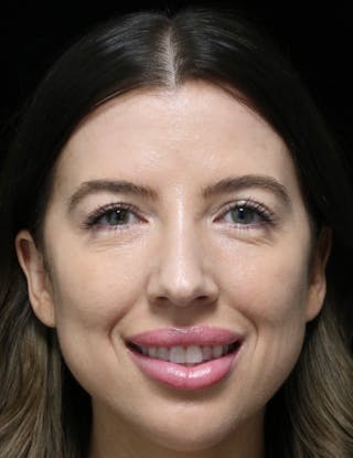 Beverly Hills Rhinoplasty Before & After Gallery - Patient 680114 - Image 12 Dr. Deepak Raj Dugar