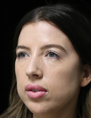 Beverly Hills Rhinoplasty Before & After Gallery - Patient 680114 - Image 8 Dr. Deepak Raj Dugar