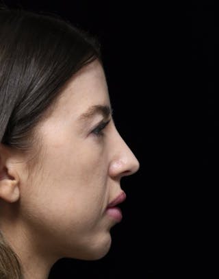 Beverly Hills Rhinoplasty Before & After Gallery - Patient 680114 - Image 2 Dr. Deepak Raj Dugar