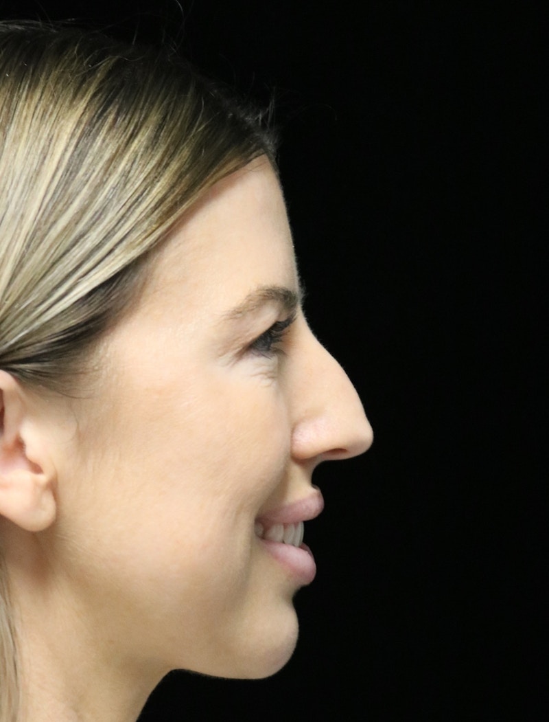 Beverly Hills Rhinoplasty Before & After Gallery - Patient 680114 - Image 3 Dr. Deepak Raj Dugar
