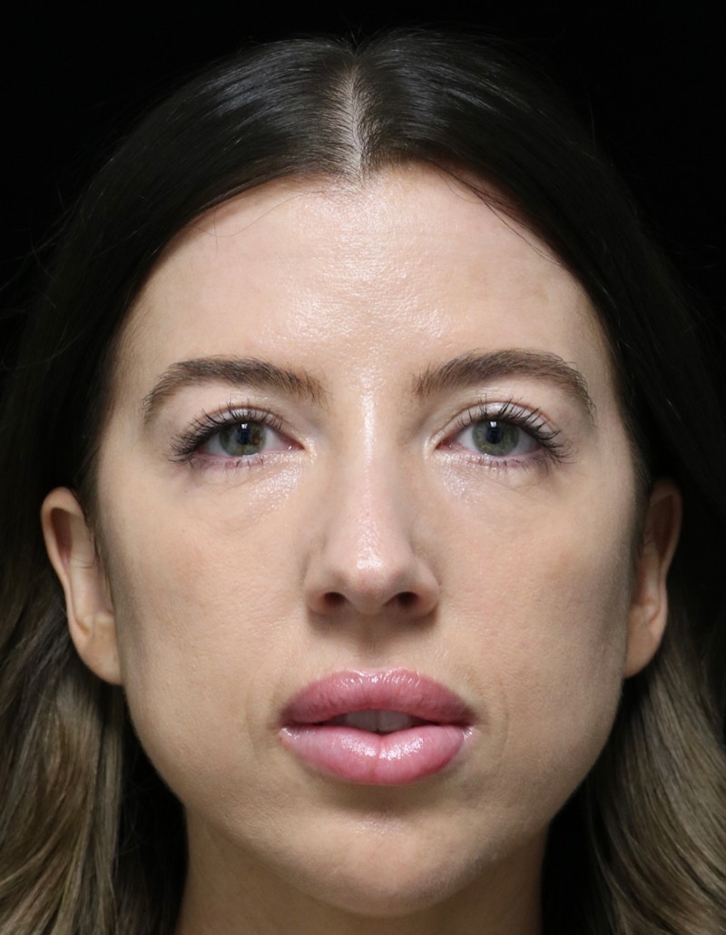 Beverly Hills Rhinoplasty Before & After Gallery - Patient 680114 - Image 10 Dr. Deepak Raj Dugar