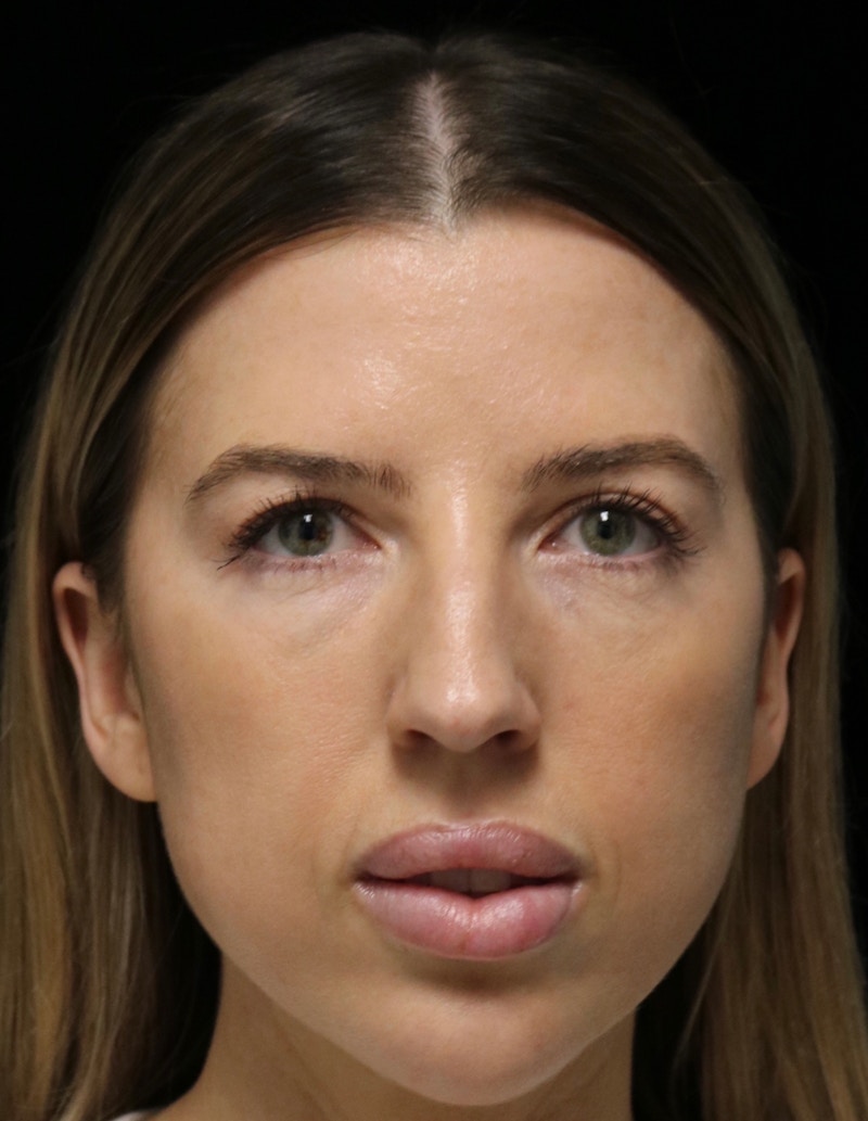Beverly Hills Rhinoplasty Before & After Gallery - Patient 680114 - Image 9 Dr. Deepak Raj Dugar