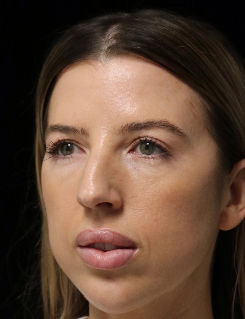 Beverly Hills Rhinoplasty Before & After Gallery - Patient 680114 - Image 7 Dr. Deepak Raj Dugar