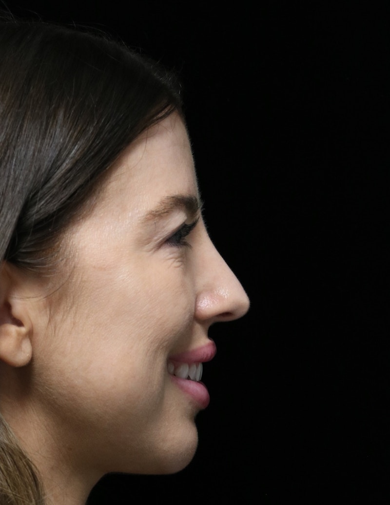 Beverly Hills Rhinoplasty Before & After Gallery - Patient 680114 - Image 4 Dr. Deepak Raj Dugar