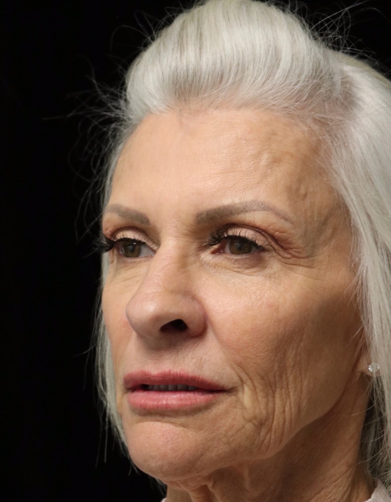 Beverly Hills Rhinoplasty Before & After Gallery - Patient 405025 - Image 8 Dr. Deepak Raj Dugar