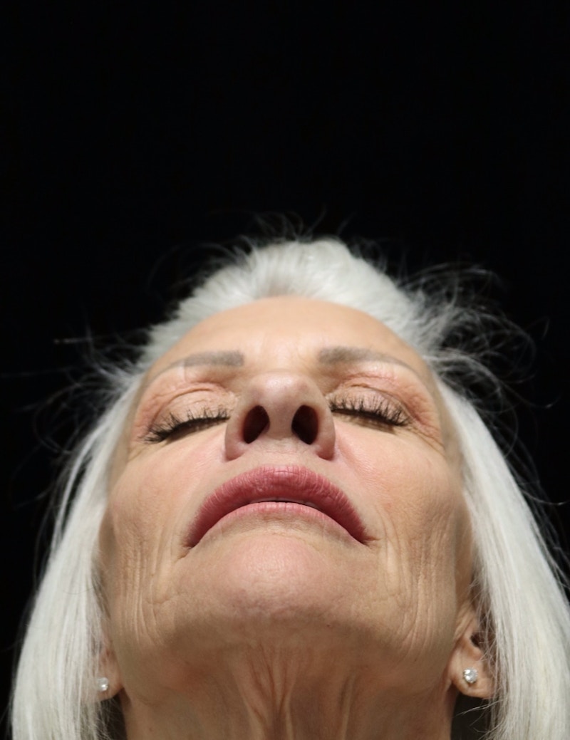 Beverly Hills Rhinoplasty Before & After Gallery - Patient 405025 - Image 14 Dr. Deepak Raj Dugar