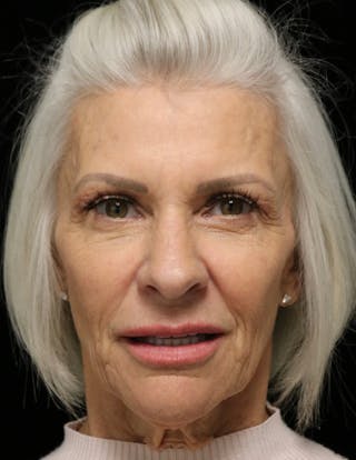 Beverly Hills Rhinoplasty Before & After Gallery - Patient 405025 - Image 10 Dr. Deepak Raj Dugar