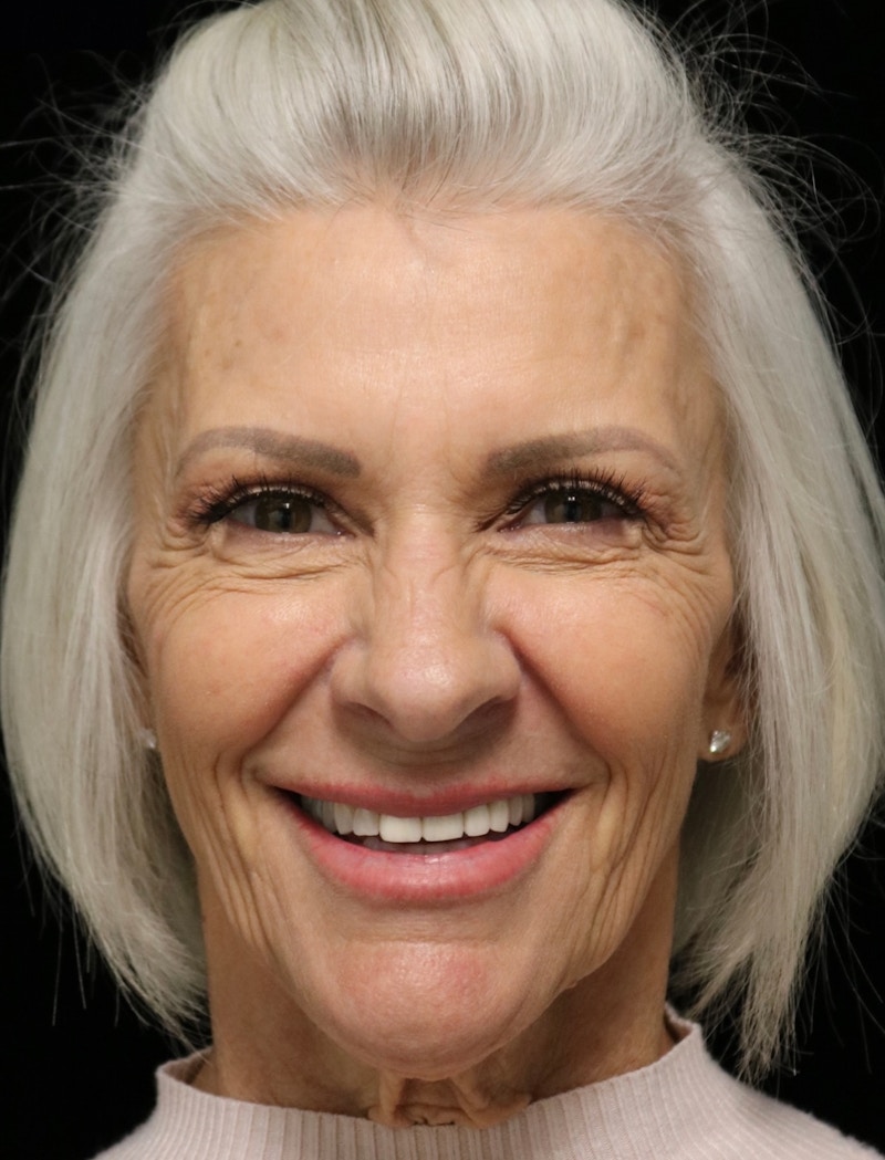 Beverly Hills Rhinoplasty Before & After Gallery - Patient 405025 - Image 12 Dr. Deepak Raj Dugar