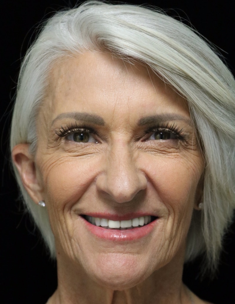 Beverly Hills Rhinoplasty Before & After Gallery - Patient 405025 - Image 11 Dr. Deepak Raj Dugar