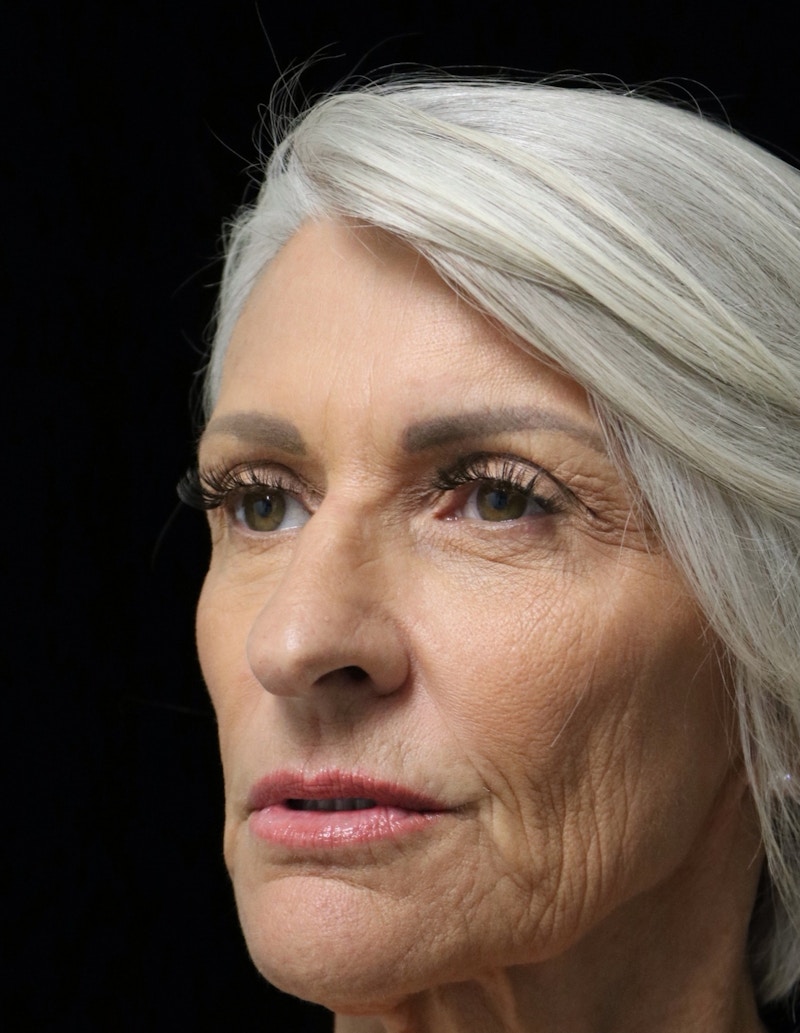 Beverly Hills Rhinoplasty Before & After Gallery - Patient 405025 - Image 7 Dr. Deepak Raj Dugar