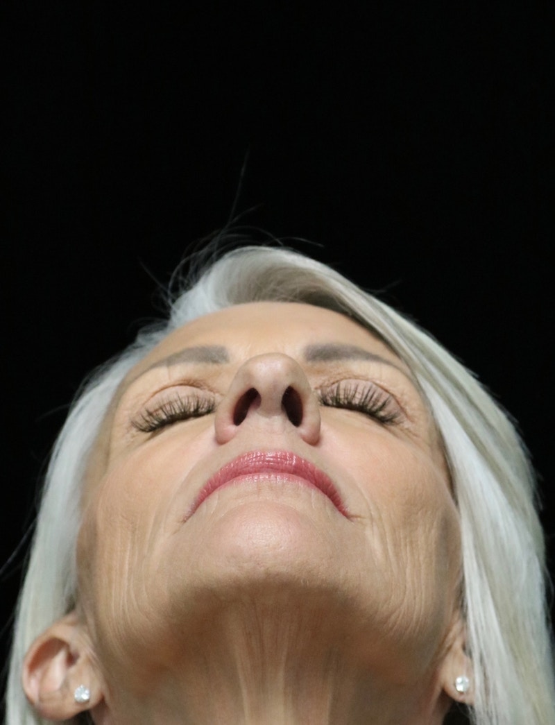 Beverly Hills Rhinoplasty Before & After Gallery - Patient 405025 - Image 13 Dr. Deepak Raj Dugar