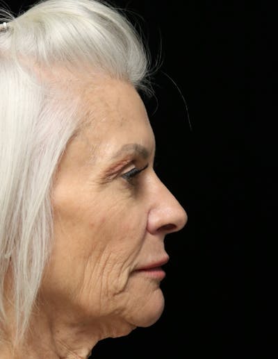 Beverly Hills Rhinoplasty Before & After Gallery - Patient 405025 - Image 2 Dr. Deepak Raj Dugar