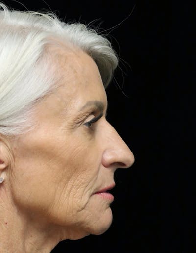 Rhinoplasty Before & After Gallery - Patient 405025 - Image 1