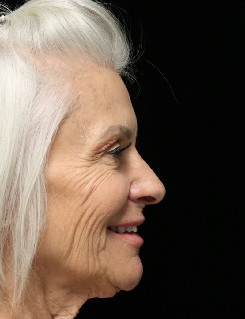 Beverly Hills Rhinoplasty Before & After Gallery - Patient 405025 - Image 4 Dr. Deepak Raj Dugar